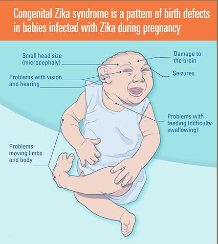 bebe con zika1
